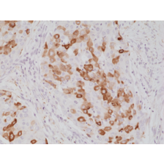 Immunohistochemical staining of formalin fixed and paraffin embedded human lung cancer tissue section using anti-Surfactant protein A (SP-A) rabbit monoclonal antibody (Clone RM334) at a 1:1000 dilution.