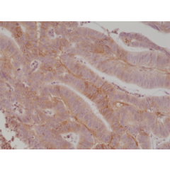 Immunohistochemical staining of formalin fixed and paraffin embedded human colon cancer tissue section using anti-CD276 (B7-H3) rabbit monoclonal antibody (Clone RM335) at a 1:1000 dilution.