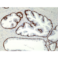 Immunohistochemical staining of formalin fixed and paraffin embedded human Prostate tissue section using anti-CK-5/CK-6 rabbit monoclonal antibody (Clone RM341) at a 1:1000 dilution.
