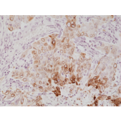 Immunohistochemical staining of formalin fixed and paraffin embedded human lung cancer tissue section using anti-COX-2 rabbit monoclonal antibody (Clone RM348) at a 1:1000 dilution.