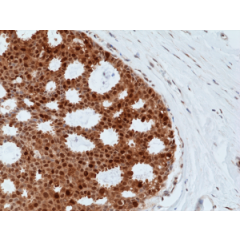 Immunohistochemical staining of formalin fixed and paraffin embedded human breast cancer tissue sections using Anti-BAG-1 Rabbit Monoclonal Antibody (Clone RM356) at a 1:500 dilution.