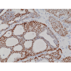 Immunohistochemical staining of formalin fixed and paraffin embedded human breast cancer tissue sections using Anti-Progesterone Receptor (PR) Rabbit Monoclonal Antibody (Clone RM357) at a 1:100 dilution.
