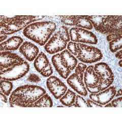 Immunohistochemical staining of formalin fixed and paraffin embedded human colon cancer tissue section using anti-SATB2 rabbit monoclonal antibody (Clone RM365) at a 1:1000 dilution.