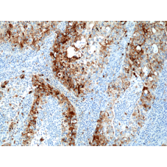 Immunohistochemical staining of formalin fixed and paraffin embedded human lung adenocarcinoma tissue section using anti-Napsin-A rabbit monoclonal antibody (Clone RM366) at a 1:2000 dilution.