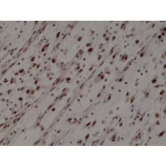 Immunohistochemical staining of formalin fixed and paraffin embedded human Rhabdomyosarcoma section using anti-MyoD1 rabbit monoclonal antibody (Clone RM369) at a 1:1000 dilution.