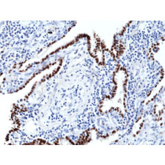 Immunohistochemical staining of formalin fixed and paraffin embedded human lung cancer tissue section using anti-TTF1 rabbit monoclonal antibody (Clone RM373) at a 1:500 dilution.