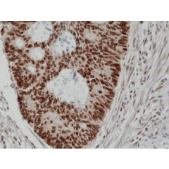Immunohistochemical staining of formalin fixed and paraffin embedded human colon cancer tissue section using anti-MSH2 rabbit monoclonal antibody (Clone RM375) at a 1:200 dilution.