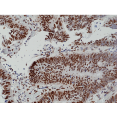 Immunohistochemical staining of formalin fixed and paraffin embedded human colon cancer tissue section using anti-MSH6 rabbit monoclonal antibody (Clone RM376) at a 1:100 dilution.