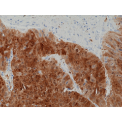 Immunohistochemical staining of formalin fixed and paraffin embedded human liver cancer tissue section using anti-ARG1 rabbit monoclonal antibody (Clone RM377) at a 1:1250 dilution.