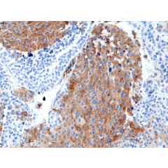 Immunohistochemical staining of formalin fixed and paraffin embedded Medullary Thyroid Carcinoma tissue section using anti-Chromogranin A rabbit monoclonal antibody (Clone RM385) at a 1:2500 dilution.