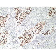Immunohistochemical staining of formalin fixed and paraffin embedded human lung cancer tissue section using anti-p53 rabbit monoclonal antibody (Clone RM 387) at a 1:100 dilution.