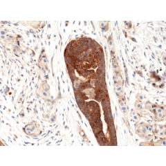 Immunohistochemical staining of formalin fixed and paraffin embedded human breast cancer tissue section using anti-VEGF rabbit monoclonal antibody (Clone RM391) at a 1:100 dilution.