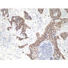 Immunohistochemical staining of formalin fixed and paraffin embedded human lung squamous carcinoma tissue section using anti-p40(ΔNp63) rabbit monoclonal antibody (Clone RM392) at a 1:50 dilution.