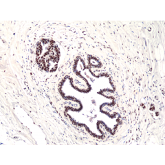 Immunohistochemical staining of formalin fixed and paraffin embedded human Glioblastoma Multiforme tissue sections with or without EGFRvIIII using anti-EGFRvIII antibody (RM419) at 1:100 dilution.
