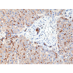 Immunohistochemical staining of formalin fixed and paraffin embedded breast ductal carcinoma section using Anti-Foxp1 Rabbit Monoclonal Antibody (Clone RM402) at a 1:200 dilution.