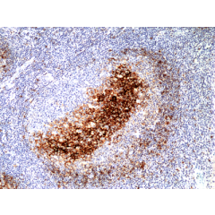 Immunohistochemical staining of formalin fixed and paraffin embedded human colon cancer tissue section using Anti-MSH3 Rabbit Monoclonal Antibody (Clone RM405) at a 1:200 dilution.