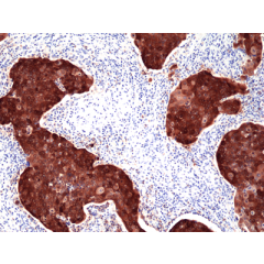 Immunohistochemical staining of formalin fixed and paraffin embedded human tonsil tissue section using Anti-ZAP70 Rabbit Monoclonal Antibody (Clone RM408) at a 1:200 dilution.