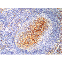 Immunohistochemical staining of formalin fixed and paraffin embedded human cervical squamous carcinoma tissue section using Anti-p16 Rabbit Monoclonal Antibody (Clone RM409) at a 1:200 dilution.