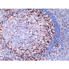 Immunohistochemical staining of formalin fixed and paraffin embedded human lung adenocarcinoma tissue section using anti-CK-7 rabbit monoclonal antibody (Clone RM416) at a 1:100 dilution.
