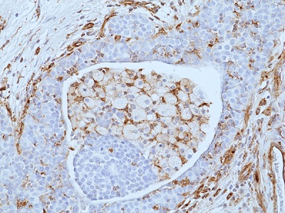 Immunohistochemical staining of formalin-fixed and paraffin embedded human breast cancer tissue sections using anti-VISTA Rabbit Monoclonal Antibody (RM503) at 1:100 dilution.