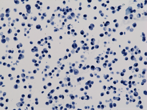 Immunocytochemical staining of HeLa cells, using anti-GAPDH RevMAb Clone RM114 at 1/200 dilution (red). Nuclei have been labeled with DAPI (blue).