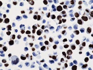 Immunohistochemical staining of formalin fixed and paraffin embedded 293T cells transfected with a DNA construct encoding Histone H3 K36M, stained with anti-Histone H3 K36M clone RM193.