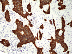 Immunohistochemical staining of formalin fixed and paraffin embedded human Lung Squamous Cell Carcinoma tissue section using anti-CK-5 rabbit monoclonal antibody (Clone RM226) at a 1:200 dilution.