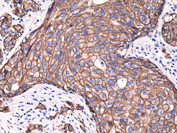 Immunohistochemical staining of FFPE humanbreast cancer tissue sections, using Anti-HER2 (c-erbB-2) Rabbit Monoclonal antibody RM228.