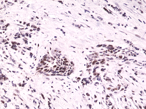 Immunohistochemical staining of formalin fixed and paraffin embedded human breast cancer tissue sections using Anti-HIF-1-alpha RM242 at a 1:1000 dilution.