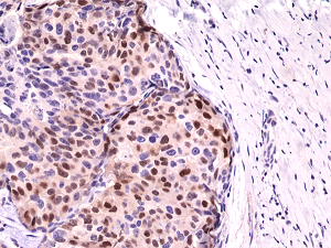 Immunohistochemical staining of formalin fixed and paraffin embedded human breast cancer tissue sections using Anti-Cyclin D1 RM241 at a 1:1000 dilution.