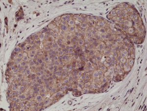 Immunohistochemical staining of formalin fixed and paraffin embedded human breast cancer tissue sections using Anti-E-cadherin RM244 at a 1:1000 dilution.