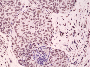 Immunohistochemical staining of formalin fixed and paraffin embedded human breast cancer tissue sections using Anti-Phospho-p38 MAPK (Thr180/Tyr182) RM243 at a 1:1000 dilution.