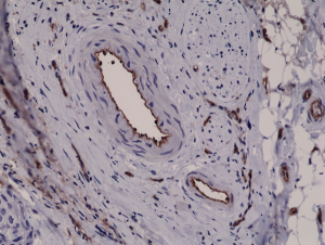 Immunohistochemical staining of formalin fixed and paraffin embedded human breast cancer tissue sections using Anti-CD31 RM247 at a 1:2500 dilution.