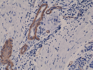 Immunohistochemical staining of formalin fixed and paraffin embedded human breast cancer tissue sections using Anti-CD146 RM249 at a 1:400 dilution.