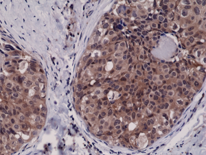 Immunohistochemical staining of formalin fixed and paraffin embedded human breast cancer tissue sections using Anti-Caspase-3 RM250 at a 1:2500 dilution.