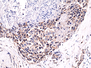 Immunohistochemical staining of formalin fixed and paraffin embedded human breast cancer tissue sections using Anti-Phospho-Akt (Ser473) RM251 at a 1:400 dilution.
