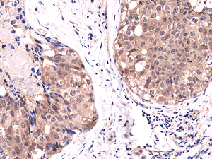 Immunohistochemical staining of formalin fixed and paraffin embedded human breast cancer tissue sections using Anti-Akt1 RM252 at a 1:1000 dilution.