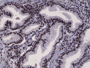 Immunohistochemical staining of formalin fixed and paraffin embedded human prostate cancer tissue section using anti-Androgen Receptor (N-term) rabbit monoclonal antibody (Clone RM254) at a 1:2500 dilution.