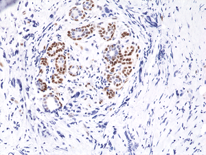 Immunohistochemical staining of formalin fixed and paraffin embedded human breast cancer tissue sections using Anti-Phospho-Stat3 (Tyr705) Rabbit Monoclonal Antibody (clone RM261) at a 1:10,000 dilution.