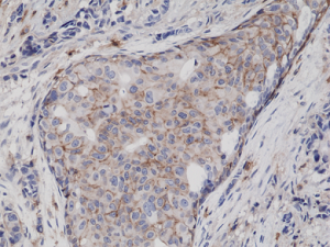 Immunohistochemical staining of formalin fixed and paraffin embedded human breast cancer tissue sections using Anti-CD44 Rabbit Monoclonal Antibody (Clone RM264) at a 1:5000 dilution.