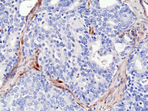 Immunohistochemical staining of formalin fixed and paraffin embedded human prostate cancer sections using Anti-PTEN RM265 at a 1:2000 dilution.