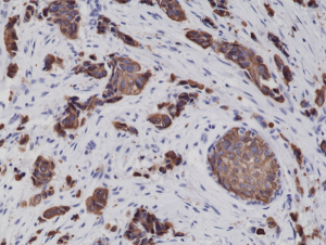 Immunohistochemical staining of formalin fixed and paraffin embedded human breast cancer tissue sections using Anti-CK8 Rabbit Monoclonal Antibody (Clone RM266) at a 1:2000 dilution.
