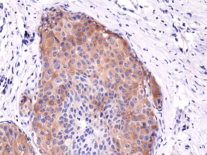 Immunohistochemical staining of formalin fixed and paraffin embedded human breast cancer tissue sections using Anti-Phospho-Acetyl CoA Carboxylase (Ser79) Rabbit Monoclonal Antibody (clone RM270) at a 1:5000 dilution.