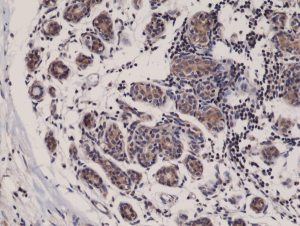 Immunohistochemical staining of formalin fixed and paraffin embedded human breast cancer tissue sections using Anti-Smac/Diablo Rabbit Monoclonal Antibody (Clone RM271) at a 1:1000 dilution.