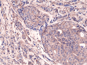 Immunohistochemical staining of formalin fixed and paraffin embedded human breast cancer tissue sections using Anti-NFkB p65 Rabbit Monoclonal Antibody (Clone RM273) at a 1:1250 dilution.