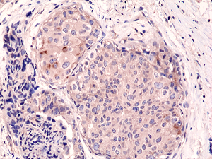 Immunohistochemical staining of formalin fixed and paraffin embedded human breast cancer tissue sections using Anti-mTOR Rabbit Monoclonal Antibody (Clone RM274) at a 1:1000 dilution.