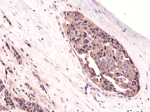 Immunohistochemical staining of formalin fixed and paraffin embedded human breast cancer tissue sections using Anti-beta-Catenin Rabbit Monoclonal Antibody (Clone RM276) at a 1:1000 dilution.