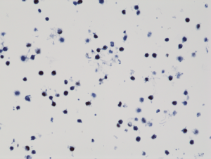 Immunohistochemical staining of formalin fixed and paraffin embedded 293T cells transfected with a DNA construct encoding Histone H3 K9M, stained with anti-Histone H3 K9M clone RM191.