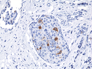 Immunohistochemical staining of formalin fixed and paraffin embedded human breast cancer tissue sections using Anti-Cyclin B1 RM281 at a 1:2000 dilution.