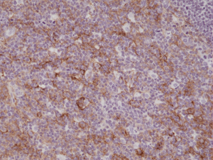Immunohistochemical staining of formalin fixed and paraffin embedded human tonsil tissue sections using anti-CD11b rabbit monoclonal antibody (clone RM290) at a 1:200 dilution.